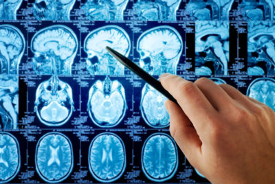 Analysis of brain x-ray scans